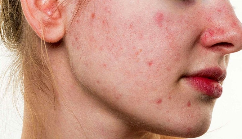 جوش صورت در قسمت‌های مختلف دلیل متفاوتی دارد.