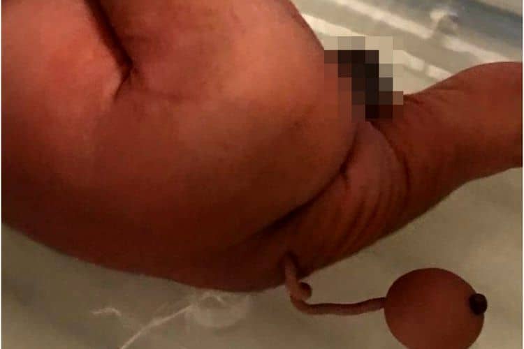 تولد نوزاد عجیبی که دم دارد